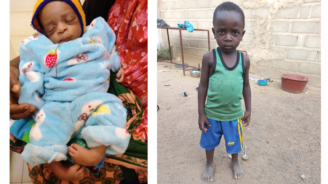 Photo of Moussa Sandwidi as a baby, with both feet bent inward. Photo of 3-year-old Moussa Sandwidi standing on his own with no longer any deformities in his feet.