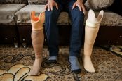 Hussein was amputated following a bombardment and now wears a prosthesis. He explains his difficulties as a person with a disability to find a job.