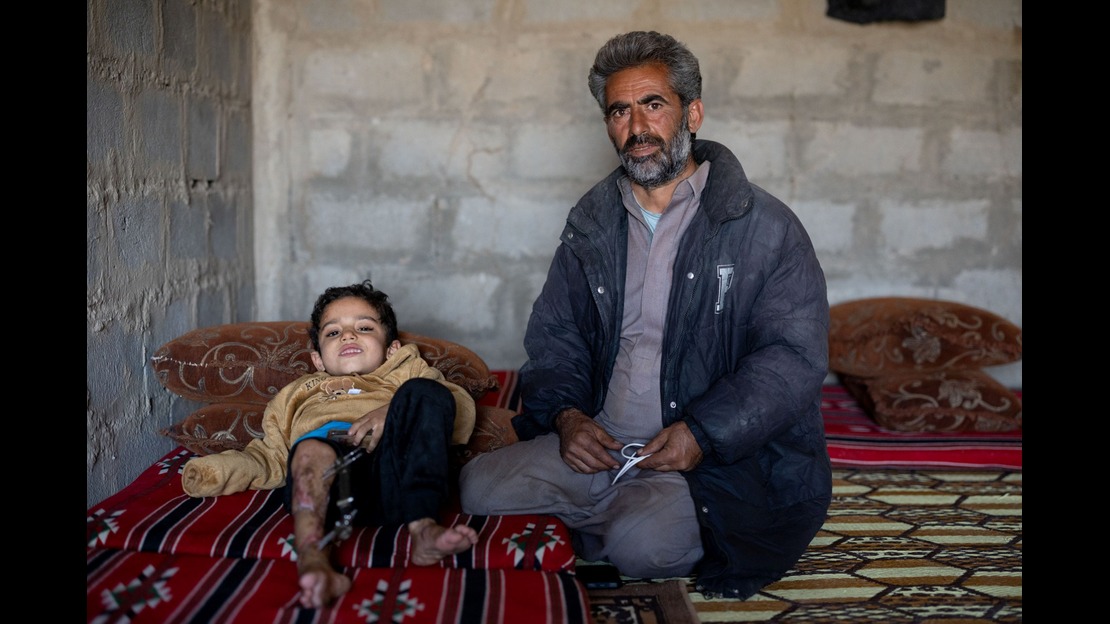 Two people are inside a room with exposed concrete walls. One person is sitting on the floor on a patterned rug, turned slightly toward the camera, wearing a dark jacket and pants, and holding a white object in their hands. Next to them, a child is lying on a mattress covered with a red patterned fabric. The child is wearing a light-colored top and dark pants. One of the child’s legs has a medical device attached to it, and the other leg shows visible injuries. The feet are visible in the foreground. Pillows are arranged behind the child and along the wall. The floor is covered with rugs featuring various patterns.