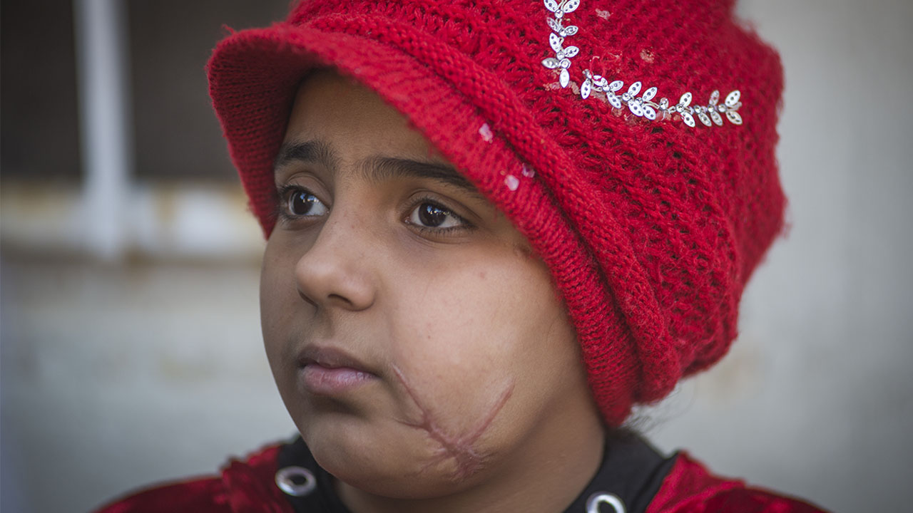 Nada is 10 years old and was injured with her father in a bombing in Mosul, in April 2017.